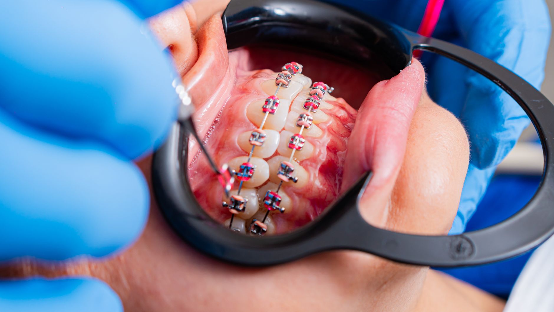 Braces Consultation